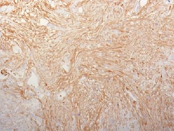IHC staining of FFPE human pancreatic adenocarcinoma tissue with Fibronectin antibody (clone HFN7.1), HRP-secondary and DAB substrate. HIER: boil tissue sections in pH 9 10mM Tris with 1mM EDTA for 20 min and allow to cool before testing.
