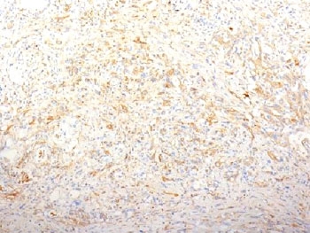 IHC testing of FFPE pancreatic adenocarcinoma and Fibronectin antibody (clone TV-1).