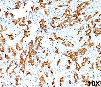 IHC testing of FFPE human breast carcinoma (10X) stained with HSP27 antibody (clone G3.1).