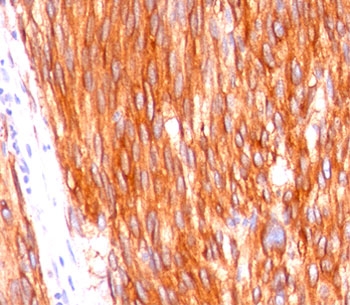 Formalin-paraffin human gastrointestinal stromal tumor (GIST) stained with CD117 antibody (clone C117/370).