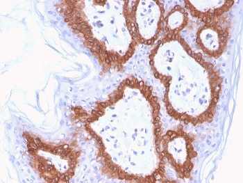 IHC staining of FFPE human skin with Cytokeratin 14 antibody (clone LL002). HIER: boil tissue sections in pH 9 10mM Tris with 1mM EDTA for 20 min and allow to cool before testing.