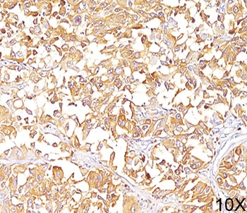 IHC staining of human melanoma (10X) with gp100 antibody (clone HMB45). HIER: boil tissue sections in pH 9 10mM Tris with 1mM EDTA for 20 min and allow to cool before testing.
