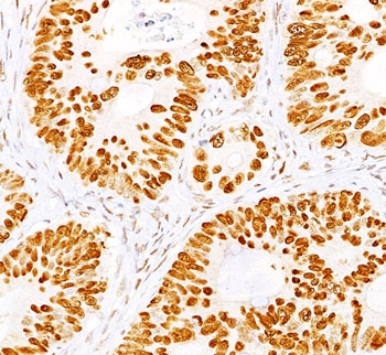 p53 antibody BP53-12 + DO-7 immunohistochemistry colon