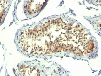 Formalin-fixed, paraffin-embedded human testicular carcinoma stained with Thymidylate Synthase antibody (clone TMS715).
