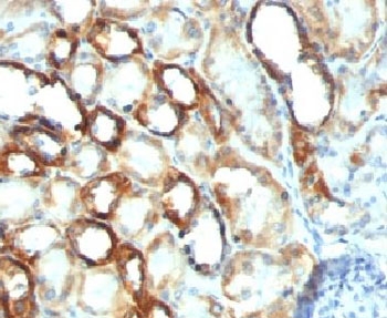 IHC testing of FFPE human renal cell carcinoma with Mitochondria marker antibody (clone MTC754).