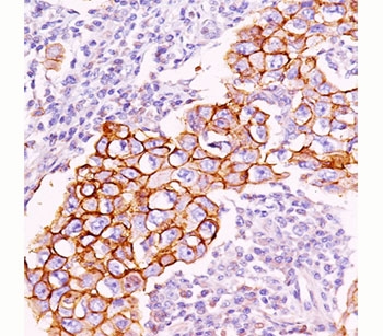 Phosphotyrosine antibody PY20 immunohistochemistry breast carcinoma