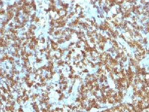 IHC testing of anti-CD45RO antibody and FFPE human lymphoma