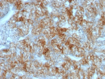 IHC testing of FFPE human renal cell carcinoma with Cadherin 16 antibody (clone CDH16/1071). Required HIER: boil tissue sections in 10mM Tris with 1mM EDTA, pH 9, for 10-20 min followed by cooling at RT for 20 min.