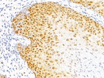IHC: Formalin-fixed, paraffin-embedded human cervical cancer stained with p27 antibody (DCS-72.F6)