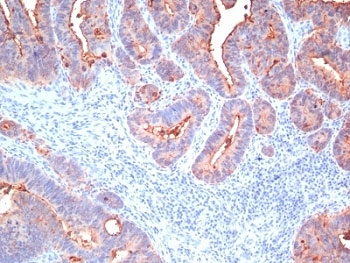 IHC: Formalin-fixed, paraffin-embedded human colon carcinoma stained with pan-CEA antibody