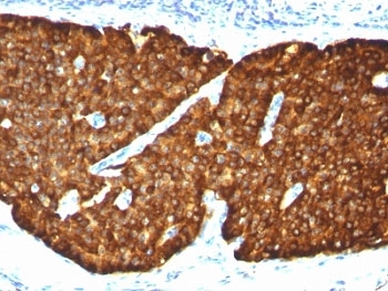 IHC: Formalin-fixed, paraffin-embedded human pheochromocytoma stained with Chromogranin A antibody (CGA/413)