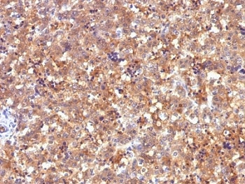 IHC: Formalin-fixed, paraffin-embedded human fetal liver stained with Alpha Fetoprotein antibody (C2).