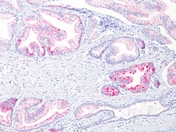 Formalin-fixed, paraffin-embedded human prostate carcinoma stained with p504S antibody (13H4)