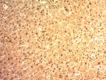 IHC: Formalin-fixed, paraffin-embedded human hepatocellular carcinoma stained with Glypican-3 antibody (clone SPM595). HIER: boil tissue sections in pH 9 10mM Tris with 1mM EDTA for 20 min and allow to cool before testing.