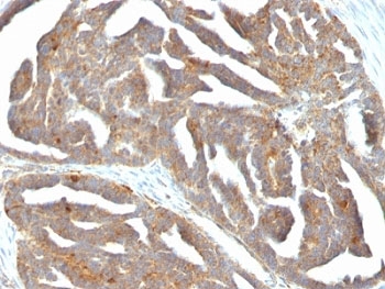 IHC: Formalin-fixed, paraffin-embedded human ovarian carcinoma stained with GnRH Receptor antibody (F1G4)