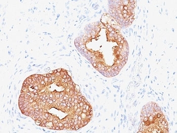 IHC: Formalin-fixed, paraffin-embedded human prostate carcinoma stained with Prostate Specific Antigen antibody (1A7).