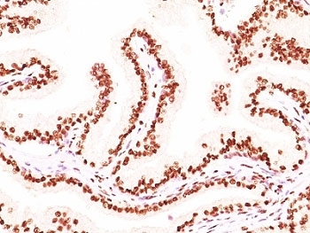 IHC: Formalin-fixed, paraffin-embedded human prostate carcinoma stained with Androgen Receptor antibody (AR441 + DHTR/882).