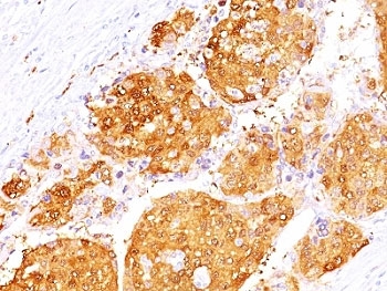 IHC: Formalin-fixed, paraffin-embedded human hepatocellular carcinoma stained with Arginase 1 antibody (ARG1/1125 + ARG1/1126).