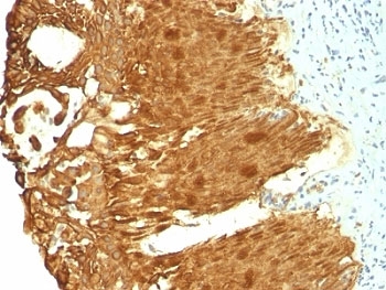 IHC: Formalin-fixed, paraffin-embedded human cervical carcinoma stained with Cytokeratin 19 antibody (KRT19/799 + KRT19/800).