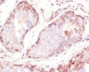 IHC: Formalin-fixed, paraffin-embedded human testicular carcinoma stained with MAGE-1 antibody (clone MZ2E/838).