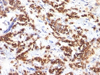 IHC analysis of formalin-fixed, paraffin-embedded human breast carcinoma stained with MFGE8 antibody (clone MFG-06).