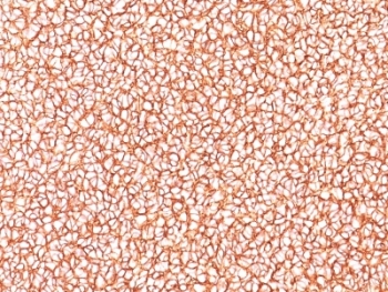 IHC: Formalin-fixed, paraffin-embedded human Ewing's sarcoma stained with CD99 antibody (SPM586).
