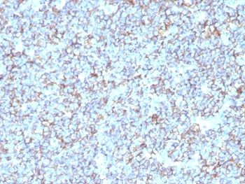 IHC: Formalin-fixed, paraffin-embedded human Ewing's sarcoma stained with anti-CD99 antibody (SPM596).
