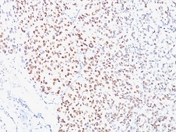 IHC analysis of formalin-fixed, paraffin-embedded human melanoma stained with MITF antibody (clone C5/D5).