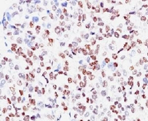 IHC: Formalin-fixed, paraffin-embedded human melanoma stained with anti-MITF antibody (clone SPM290).