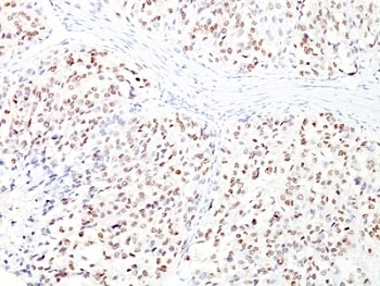 IHC: Formalin-fixed, paraffin-embedded human melanoma stained with MITF antibody cocktail (clones D5 + MITF/915).