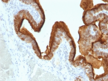 IHC: Formalin-fixed, paraffin-embedded human ovarian carcinoma stained with anti-MUC1 antibody (clone SPM493).