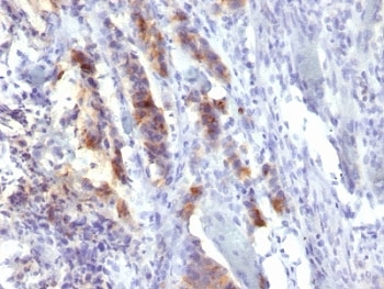 IHC: Formalin-fixed, paraffin-embedded human gastric carcinoma stained with MUC5-AC antibody (SPM488).