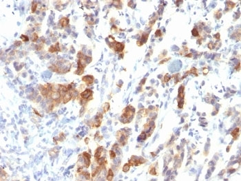 IHC: Formalin-fixed, paraffin-embedded human gastric carcinoma stained with MUC5AC antibody (MUC5AC/917).