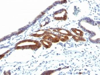 IHC: Formalin-fixed, paraffin-embedded human gastric carcinoma stained with anti-MUC6 antibody (SPM598).
