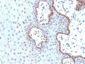 IHC analysis of formalin-fixed, paraffin-embedded human cervical carcinoma stained with c-Myc antibody (clone 9E10.3).