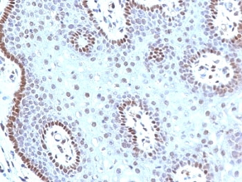 IHC: Formalin-fixed, paraffin-embedded human cervical carcinoma stained with c-Myc antibody (MYC909).