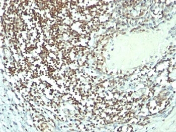 IHC: Formalin-fixed, paraffin-embedded human bladder carcinoma stained with Nucleolin antibody (364-5 + NCL/902).