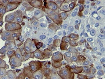 IHC analysis of formalin-fixed, paraffin-embedded human melanoma stained with p75NTR antibody (clone NGFR5).