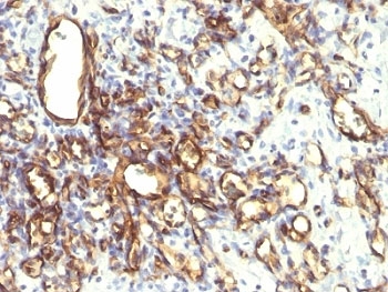 IHC: Formalin-fixed, paraffin-embedded human angiosarcoma stained with Podocalyxin antibody (2A4).