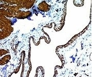 IHC: Formalin-fixed, paraffin-embedded human colon carcinoma stained with alpha Smooth Muscle Actin antibody (clone ACTA2/791).