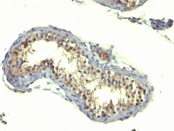 IHC: Formalin-fixed, paraffin-embedded human testicular carcinoma stained with TGFa antibody (TG86)