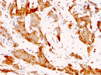 IHC analysis of formalin-fixed, paraffin-embedded human breast carcinoma stained with GRP94 antibody (clone 9G10.F8.2).