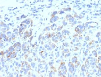 IHC: Formalin-fixed, paraffin-embedded human melanoma stained with TRP1 antibody (SPM611)
