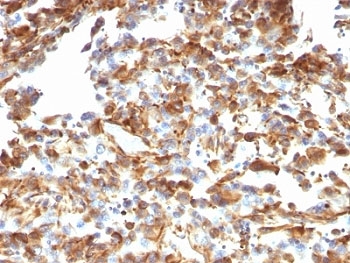 IHC: Formalin-fixed, paraffin-embedded human melanoma stained with anti-Vimentin antibody (clone VM1170).