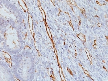 IHC analysis of formalin-fixed, paraffin-embedded human colon carcinoma stained with CD31 antibody (clone JC/70A).