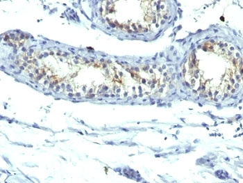 IHC: Formalin-fixed, paraffin-embedded human testicular carcinoma stained with Prolactin Receptor antibody (B6.2 + PRLR742).