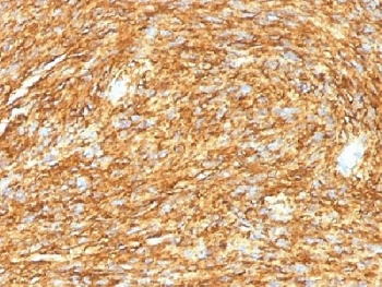 IHC testing of FFPE human gastrointestinal stromal tumor (GIST) with DOG1 antibody (DG1/1485). Required HIER: boil tissue sections in pH 9 10mM Tris with 1mM EDTA for 10-20 min.
