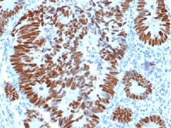 IHC testing of FFPE human colon carcinoma with p53 antibody. Required HIER: boil tissue sections in 10mM citrate buffer, pH 6, for 10-20 min.