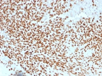 IHC testing of FFPE Ewings sarcoma with NKX2.2 antibody (clone NX2/1523). HIER: steam sections in pH 9 10mM Tris with 1mM EDTA for 10-20 min.