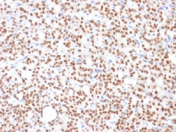 IHC testing of FFPE human thyroid carcinoma with PAX8 antibody (clone PAX8/1492). Required HIER: boil tissue sections in 10mM Tris buffer with 1mM EDTA, pH 9, for 10-20 min followed by cooling at RT for 20 minutes.